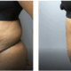 before and after tummy tuck