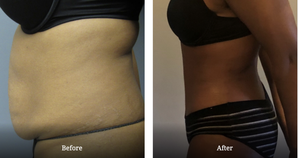 body contouring surgery before and after tummy tuck 