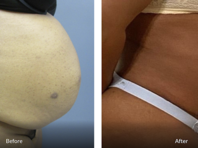 43 year old female tummy tuck front view after 10 months post op featured image