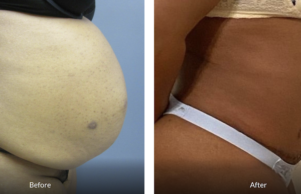 43 year old female tummy tuck front view after 10 months post op featured image