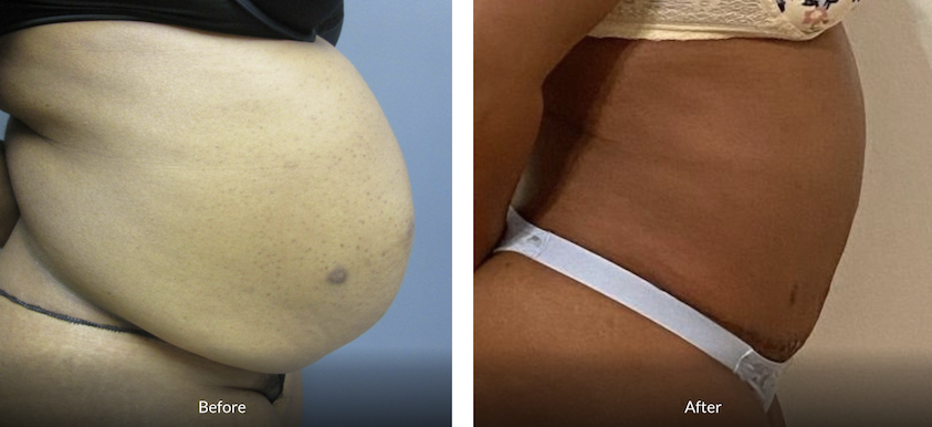 43 year old female tummy tuck front view after 10 months post op featured image
