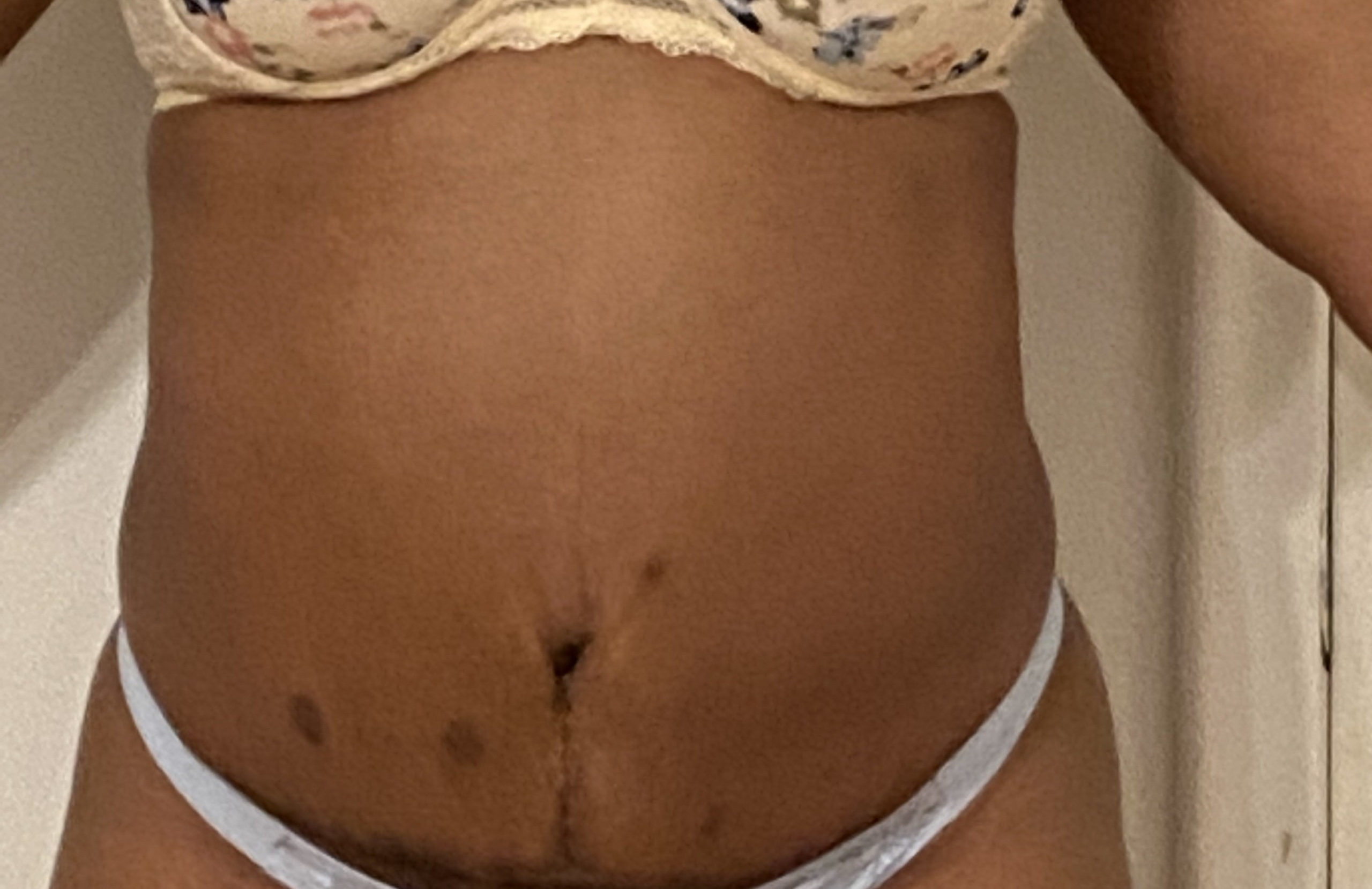 43 year old female tummy tuck front view after 10 months post op