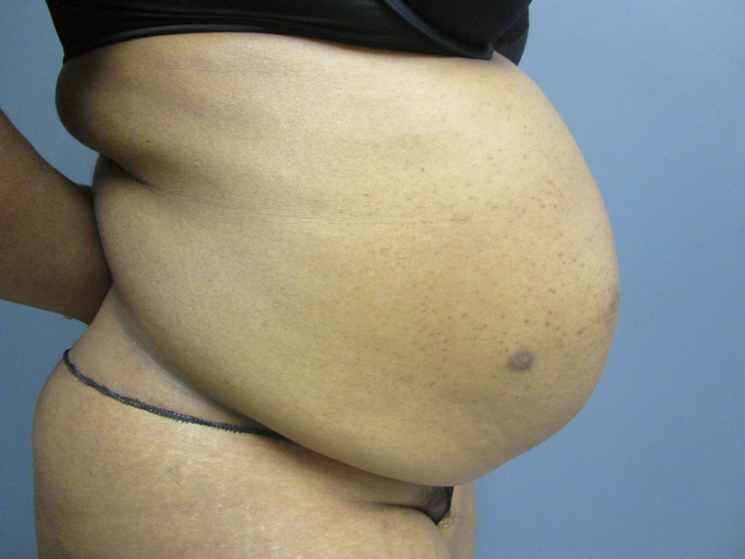 43 year old female tummy tuck right side view before