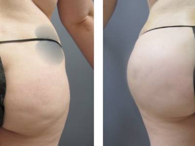 30 yr old female 5'5 195 lb After Fat Transfer to Buttocks After