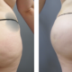 30 yr old female 5'5 195 lb After Fat Transfer to Buttocks After