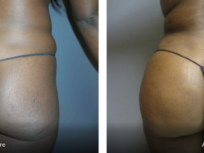 36 year old female 4 months after BBL (fat transfer to the buttocks