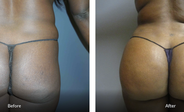 36 year old female 4 months after BBL (fat transfer to the buttocks