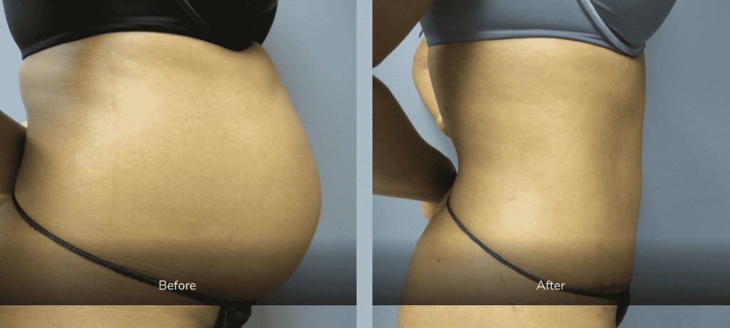sample before and after body contouring image