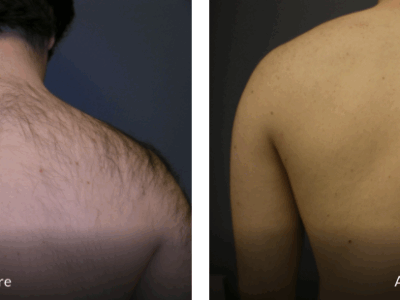 Before and After Back Laser Hair Removal
