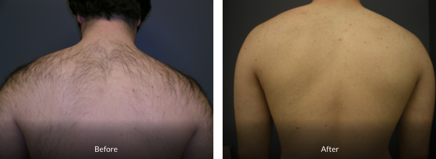 minimally invasive Before and After Back Laser Hair Removal
