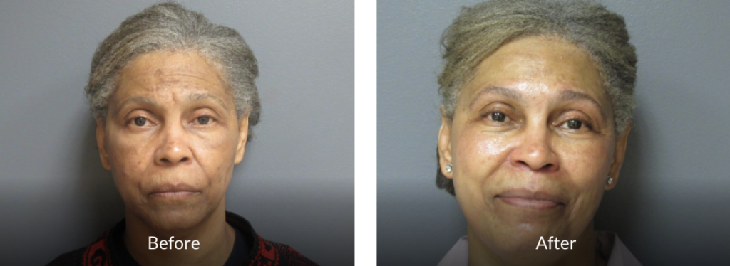 59 year old before and after fraxel laser