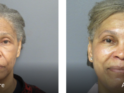 59 year old before and after fraxel laser