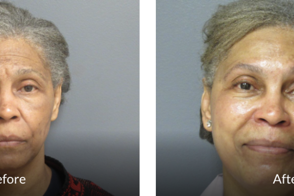 59 year old before and after fraxel laser