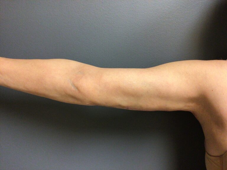 After arm lift 3 months