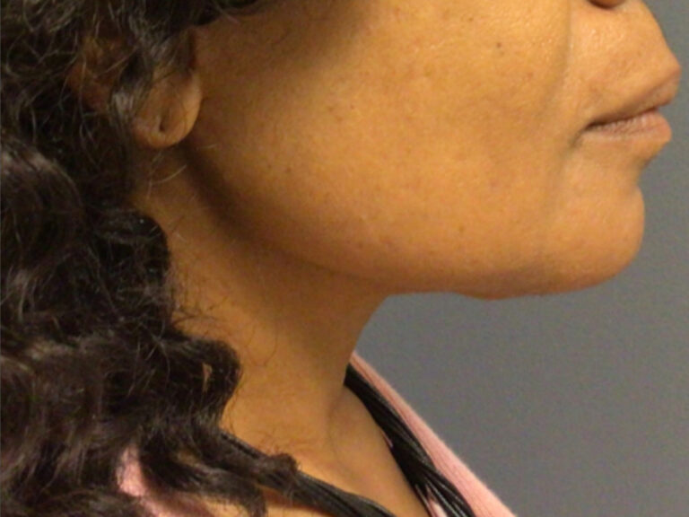 neck lift after