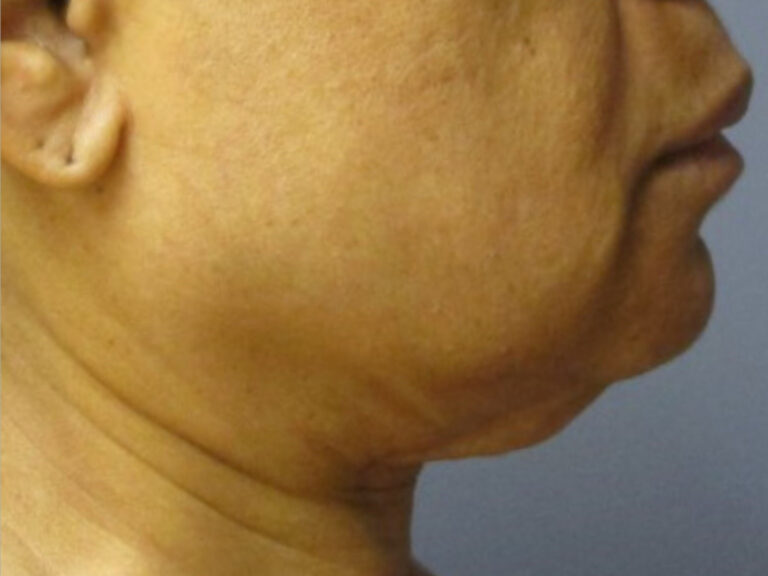 neck lift before