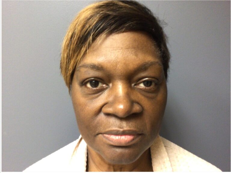 blepharoplasty before and after