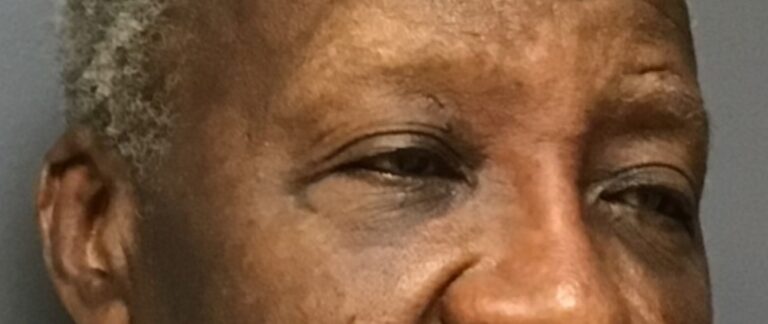 After filler injection, angled view close up(2)