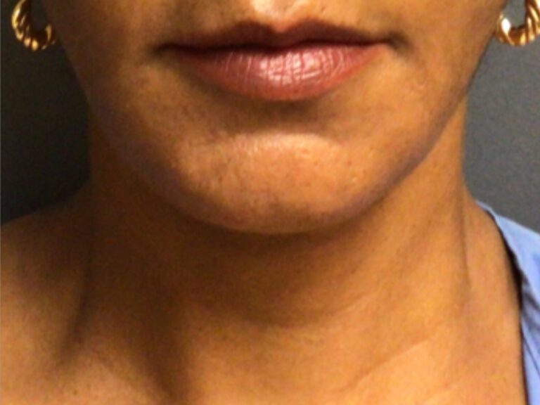 neck lift