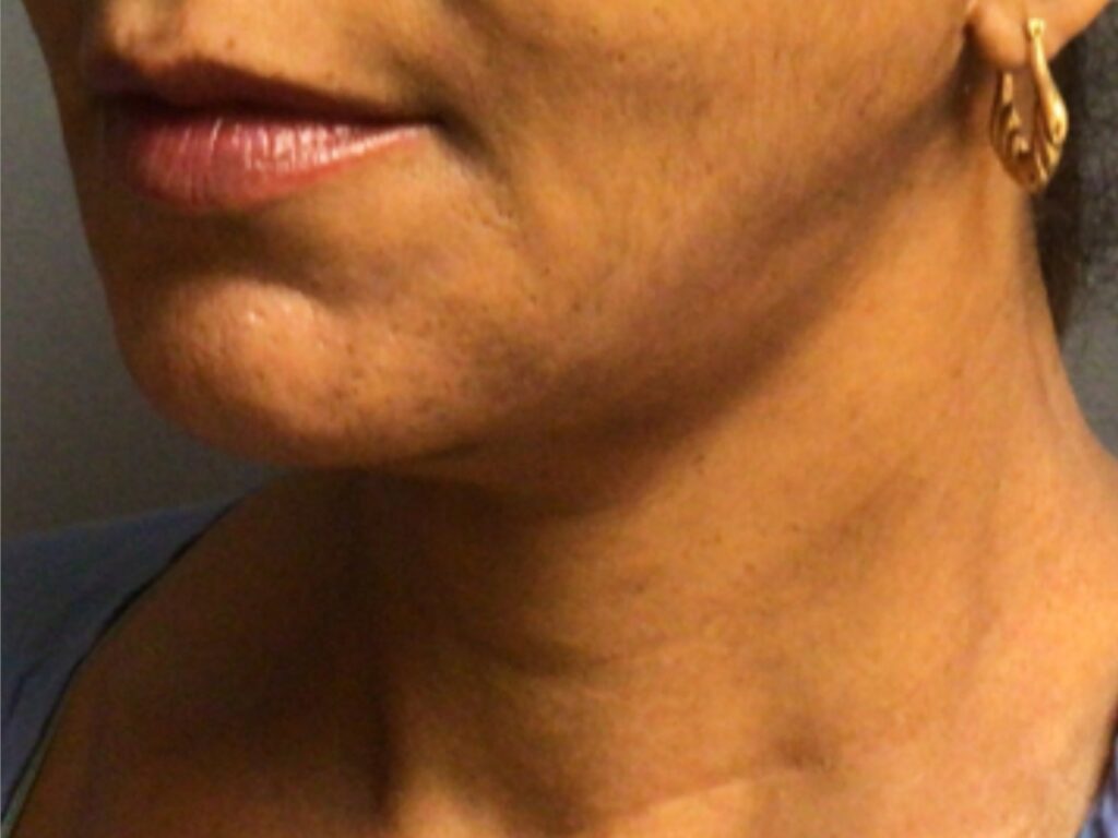 neck lift