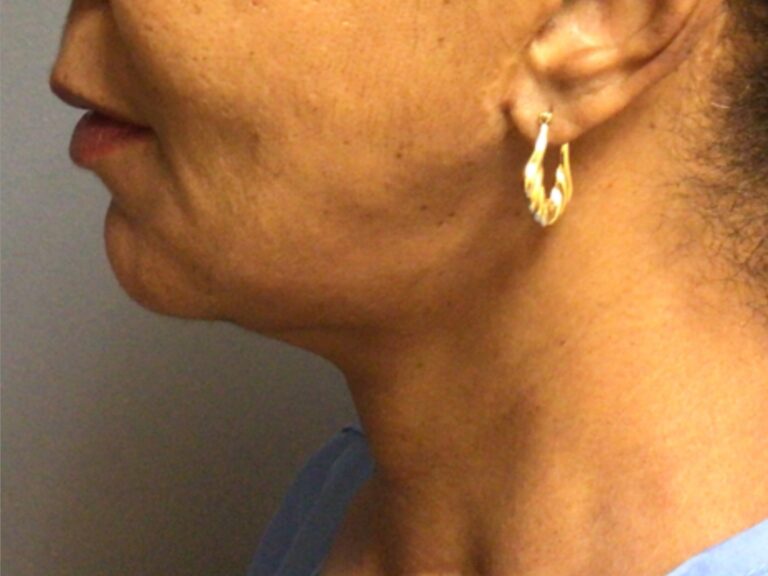neck lift