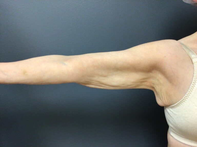 Before brachioplasty surgery