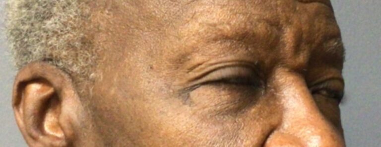 Before filler injected, angled view close up (2)