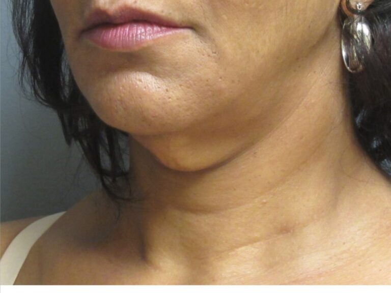 neck lift