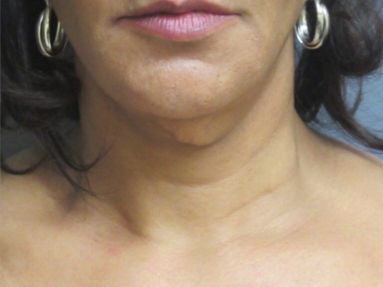 neck lift