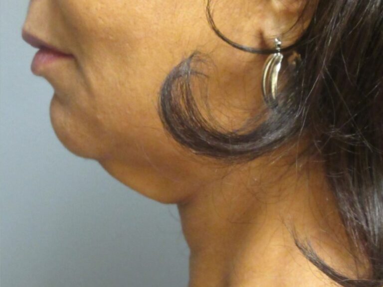 neck lift