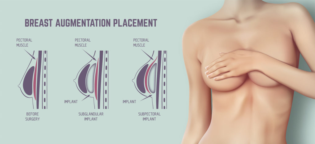 Diagram about method of insertion for breast implant. Plastic surgery of breast implants illustration.