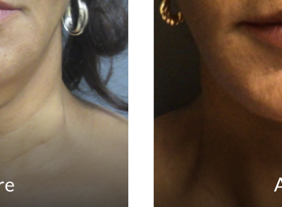 neck lift before and after