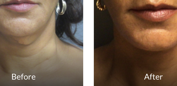 neck lift before and after