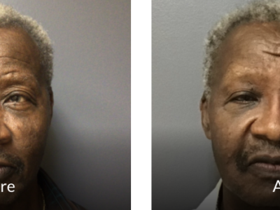 72 year old male before and after fillers