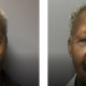 72 year old male before and after fillers