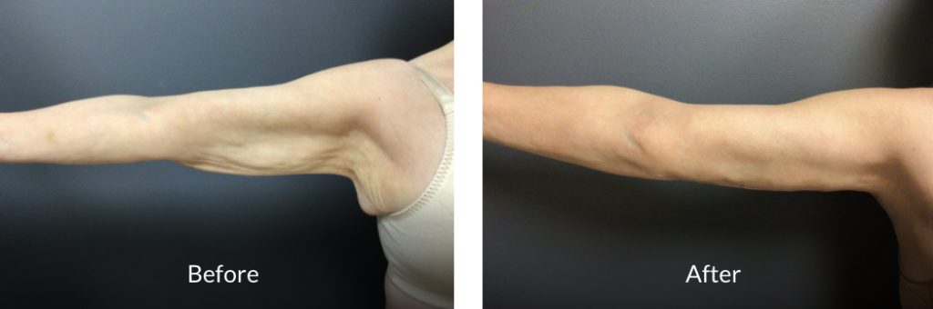 body contouring surgery 65 year old before and after arm lift or brachioplasty