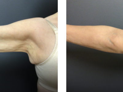 65 year old before and after arm lift or brachioplasty