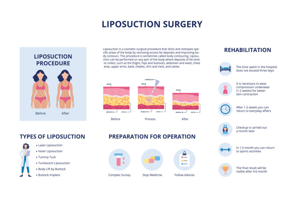 types of liposuction Liposuction and body plastic surgery procedure and rehabilitation - educational medical banner template with flat cartoon characters and text,  illustration.