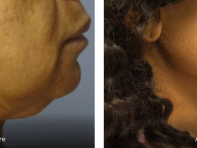 neck lift 59 year old before and after