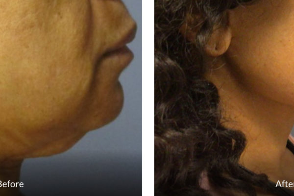 neck lift 59 year old before and after