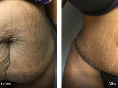 32 year old before and after tummy tuck and vaser liposuction of the back