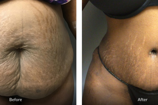 32 year old before and after tummy tuck and vaser liposuction of the back