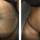 32 year old before and after tummy tuck and vaser liposuction of the back