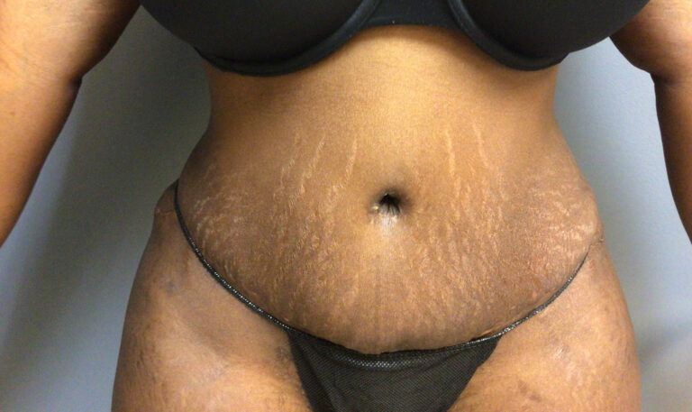 32 year old female 4 months post op