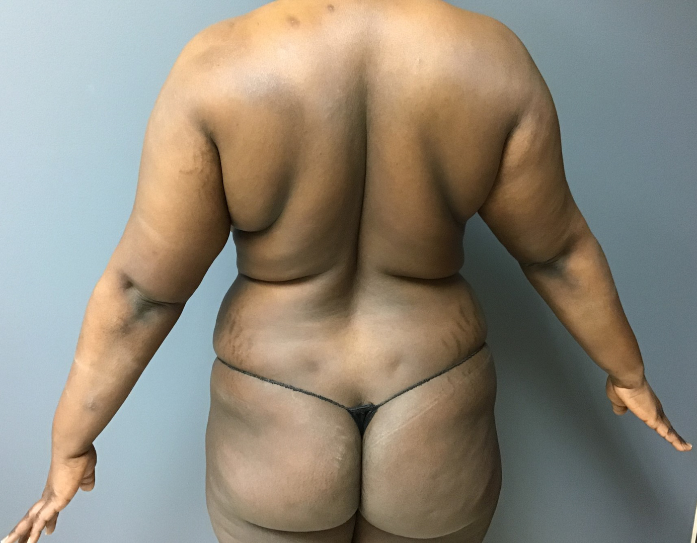 32 year old female before Vaser liposuction of the back
