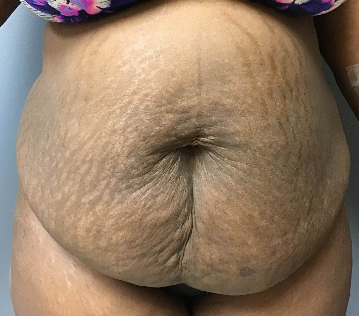 32 year old female before surgery