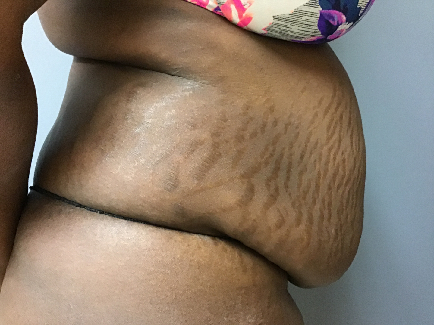 32 year old female right side before surgery
