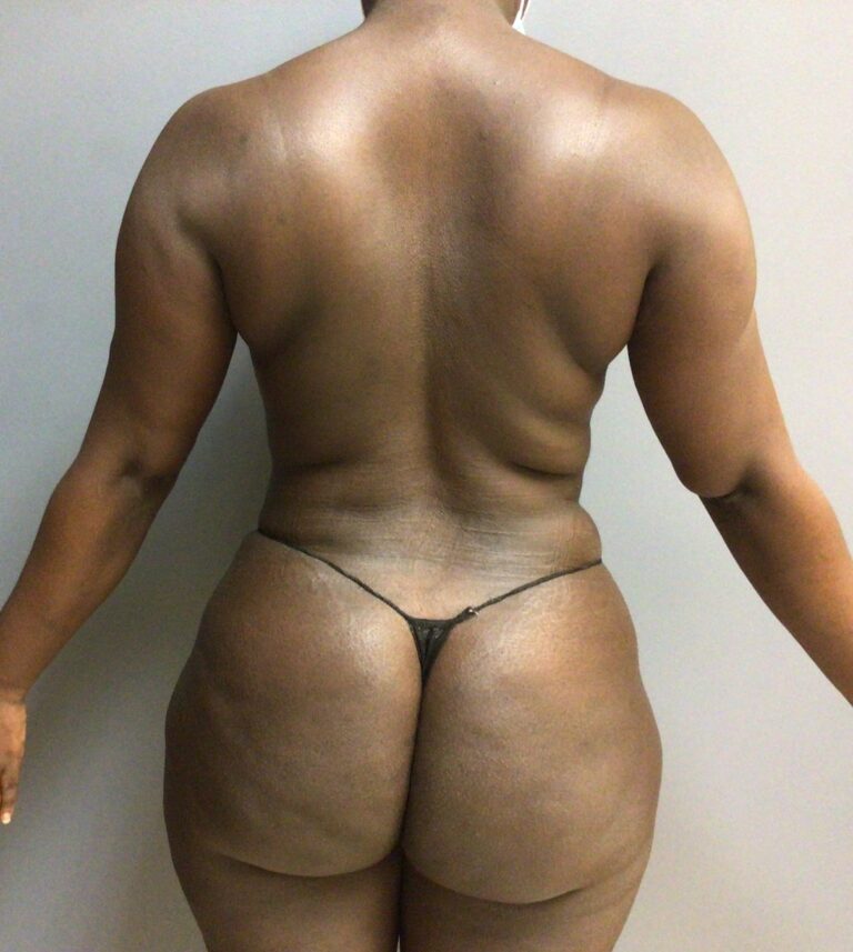 33 year old female back 3 months post surgery