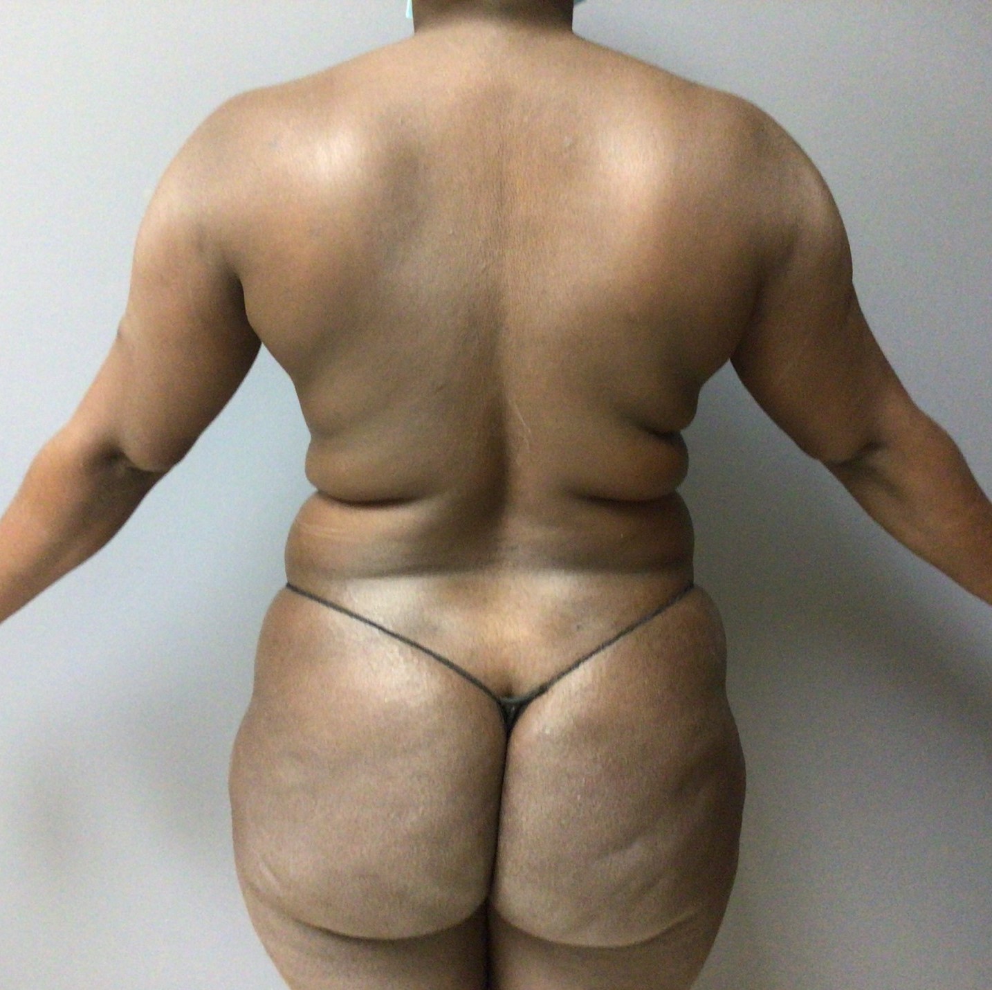 33 year old female back before surgery