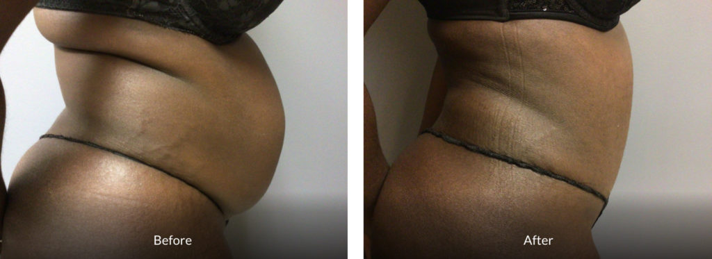 33 year old female before and after tummy tuck and back liposuction